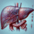 Advanced Liver Blood Test: Comprehensive Insights in Tewkesbury